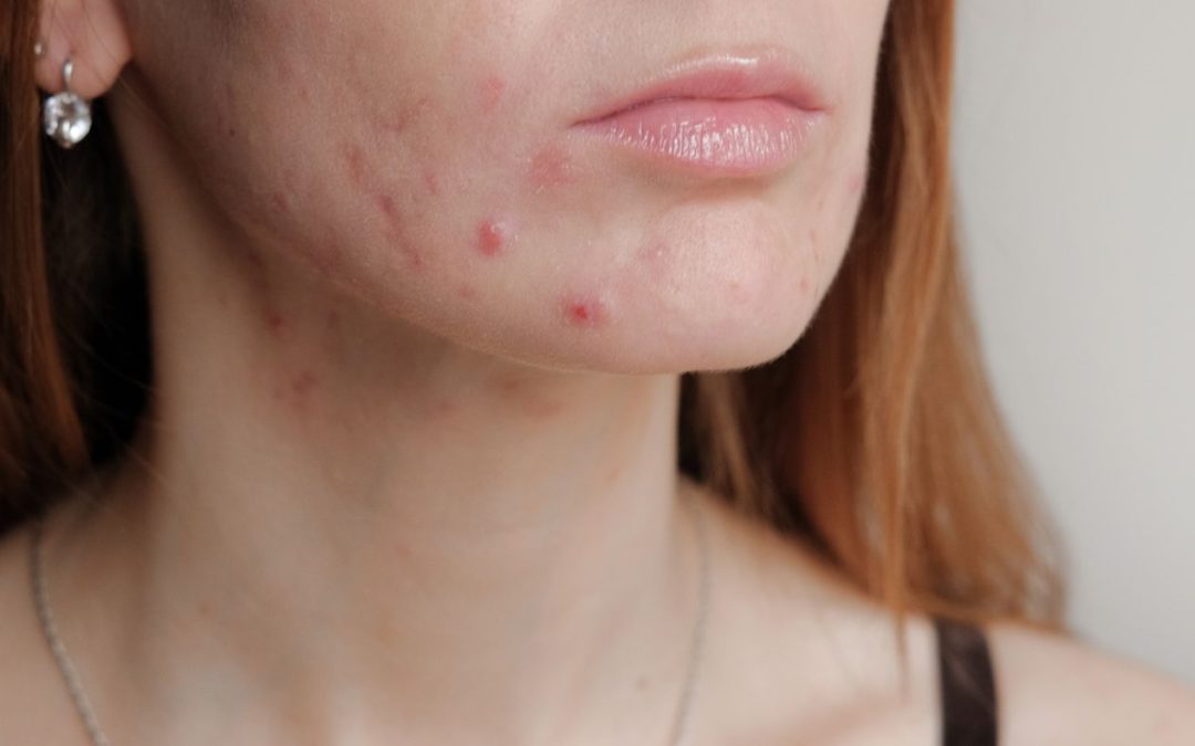 Comment faire votre détox contre l’acné ?
