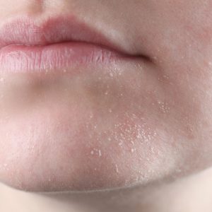 Eau florale peau sèche
