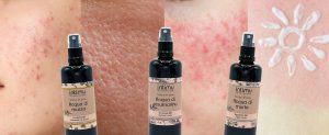 Apaiser votre peau à problème avec un hydrolat BIO adapté