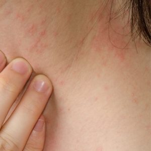 eczema