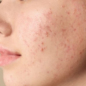 Quel hydrolat pour votre peau acnéique ?