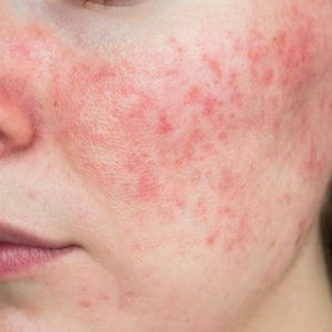 Quel hydrolat pour votre peau avec rougeurs : rosacée ?