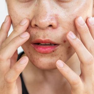 Quel hydrolat pour votre peau grasse ?