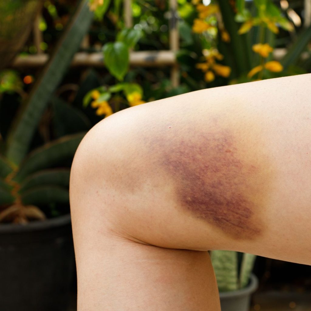 L'immortelle de Corse est l'anti-hématome le plus puissant au monde